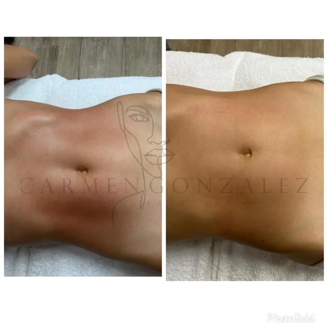 Resultado: abdomen antes y despuÃ©s