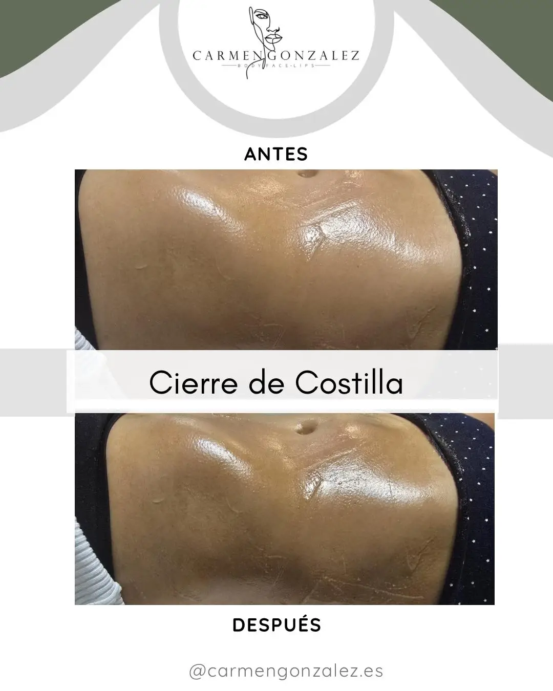 Resultado: cierre de costilla antes y despuÃ©s